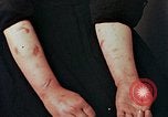 Image of Japanese nurse with atomic bomb scars Hiroshima Japan, 1945, second 27 stock footage video 65675042171