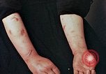 Image of Japanese nurse with atomic bomb scars Hiroshima Japan, 1945, second 28 stock footage video 65675042171