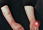 Image of Japanese nurse with atomic bomb scars Hiroshima Japan, 1945, second 29 stock footage video 65675042171