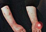 Image of Japanese nurse with atomic bomb scars Hiroshima Japan, 1945, second 30 stock footage video 65675042171