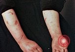 Image of Japanese nurse with atomic bomb scars Hiroshima Japan, 1945, second 31 stock footage video 65675042171