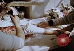 Image les blessures aux jambes de bombe atomique Hiroshima au Japon, 1945, de la seconde 34 séquences d'archives historiques vidéo 65675042173