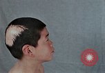 Standbild Haarausfall Nagasaki Japan, 1946, aus Sekunde 36 historischem Filmmaterial Videoclip 65675042176