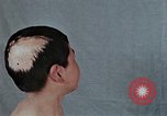 Standbild Haarausfall Nagasaki Japan, 1946, aus Sekunde 38 historischem Filmmaterial Videoclip 65675042176