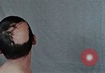 Standbild Haarausfall Nagasaki Japan, 1946, aus Sekunde 43 historischem Filmmaterial Videoclip 65675042176