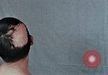 Standbild Haarausfall Nagasaki Japan, 1946, aus Sekunde 45 historischem Filmmaterial Videoclip 65675042176