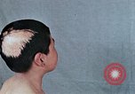 Standbild Haarausfall Nagasaki Japan, 1946, aus Sekunde 51 historischem Filmmaterial Videoclip 65675042176