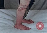 Image of flash burn on face from atomic bomb Nagasaki Japan, 1946, second 4 stock footage video 65675042177
