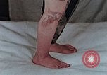 Image of flash burn on face from atomic bomb Nagasaki Japan, 1946, second 5 stock footage video 65675042177