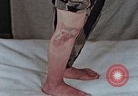 Image of flash burn on face from atomic bomb Nagasaki Japan, 1946, second 6 stock footage video 65675042177
