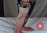 Image of flash burn on face from atomic bomb Nagasaki Japan, 1946, second 8 stock footage video 65675042177