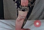 Image of flash burn on face from atomic bomb Nagasaki Japan, 1946, second 10 stock footage video 65675042177