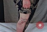 Image of flash burn on face from atomic bomb Nagasaki Japan, 1946, second 11 stock footage video 65675042177