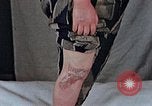 Image of flash burn on face from atomic bomb Nagasaki Japan, 1946, second 12 stock footage video 65675042177