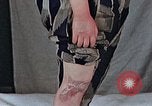Image of flash burn on face from atomic bomb Nagasaki Japan, 1946, second 14 stock footage video 65675042177