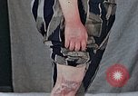 Image of flash burn on face from atomic bomb Nagasaki Japan, 1946, second 15 stock footage video 65675042177