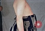 Image of flash burn on face from atomic bomb Nagasaki Japan, 1946, second 26 stock footage video 65675042177