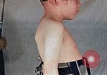 Image of flash burn on face from atomic bomb Nagasaki Japan, 1946, second 30 stock footage video 65675042177