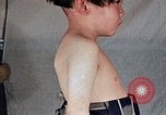Image of flash burn on face from atomic bomb Nagasaki Japan, 1946, second 31 stock footage video 65675042177