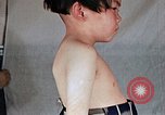 Image of flash burn on face from atomic bomb Nagasaki Japan, 1946, second 32 stock footage video 65675042177