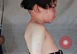 Image of flash burn on face from atomic bomb Nagasaki Japan, 1946, second 33 stock footage video 65675042177
