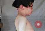 Image of flash burn on face from atomic bomb Nagasaki Japan, 1946, second 34 stock footage video 65675042177