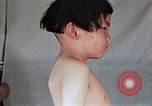 Image of flash burn on face from atomic bomb Nagasaki Japan, 1946, second 35 stock footage video 65675042177