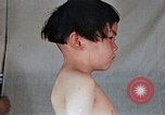 Image of flash burn on face from atomic bomb Nagasaki Japan, 1946, second 36 stock footage video 65675042177