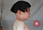 Image of flash burn on face from atomic bomb Nagasaki Japan, 1946, second 37 stock footage video 65675042177