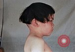 Image of flash burn on face from atomic bomb Nagasaki Japan, 1946, second 38 stock footage video 65675042177