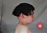 Image of flash burn on face from atomic bomb Nagasaki Japan, 1946, second 39 stock footage video 65675042177