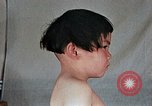 Image of flash burn on face from atomic bomb Nagasaki Japan, 1946, second 40 stock footage video 65675042177