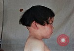 Image of flash burn on face from atomic bomb Nagasaki Japan, 1946, second 41 stock footage video 65675042177