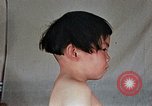 Image of flash burn on face from atomic bomb Nagasaki Japan, 1946, second 42 stock footage video 65675042177