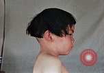 Image of flash burn on face from atomic bomb Nagasaki Japan, 1946, second 43 stock footage video 65675042177