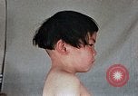 Image of flash burn on face from atomic bomb Nagasaki Japan, 1946, second 44 stock footage video 65675042177
