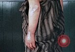 Image of flash burn on face from atomic bomb Nagasaki Japan, 1946, second 46 stock footage video 65675042177