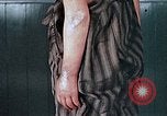 Image of flash burn on face from atomic bomb Nagasaki Japan, 1946, second 47 stock footage video 65675042177