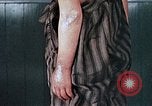 Image of flash burn on face from atomic bomb Nagasaki Japan, 1946, second 48 stock footage video 65675042177