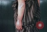 Image of flash burn on face from atomic bomb Nagasaki Japan, 1946, second 50 stock footage video 65675042177