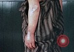 Image of flash burn on face from atomic bomb Nagasaki Japan, 1946, second 51 stock footage video 65675042177