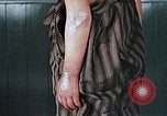 Image of flash burn on face from atomic bomb Nagasaki Japan, 1946, second 52 stock footage video 65675042177