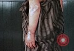 Image of flash burn on face from atomic bomb Nagasaki Japan, 1946, second 54 stock footage video 65675042177