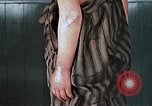 Image of flash burn on face from atomic bomb Nagasaki Japan, 1946, second 56 stock footage video 65675042177
