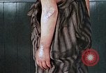 Image of flash burn on face from atomic bomb Nagasaki Japan, 1946, second 57 stock footage video 65675042177