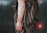 Image of flash burn on face from atomic bomb Nagasaki Japan, 1946, second 59 stock footage video 65675042177