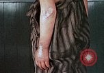 Image of flash burn on face from atomic bomb Nagasaki Japan, 1946, second 60 stock footage video 65675042177
