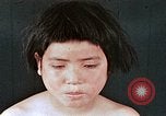 Image of flash burn on face from atomic bomb Nagasaki Japan, 1946, second 61 stock footage video 65675042177