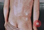 Standbild flash Brennen auf junge Opfer der Atombombe Nagasaki Japan, 1946, aus Sekunde 3 historischem Filmmaterial Videoclip 65675042178