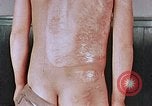 Standbild flash Brennen auf junge Opfer der Atombombe Nagasaki Japan, 1946, aus Sekunde 11 historischem Filmmaterial Videoclip 65675042178